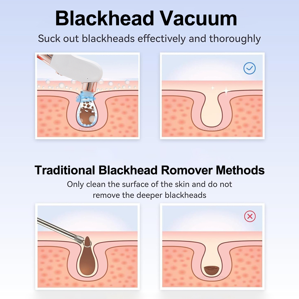 Aspirapolvere elettrico per la - Blackhead Remover Vacuum Suction recensione e prezzo