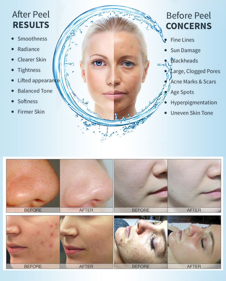 Apparecchiatura Hydra 4 in 1 p - Hydra Dermabrasion Aqua Peel Machine recensione e prezzo