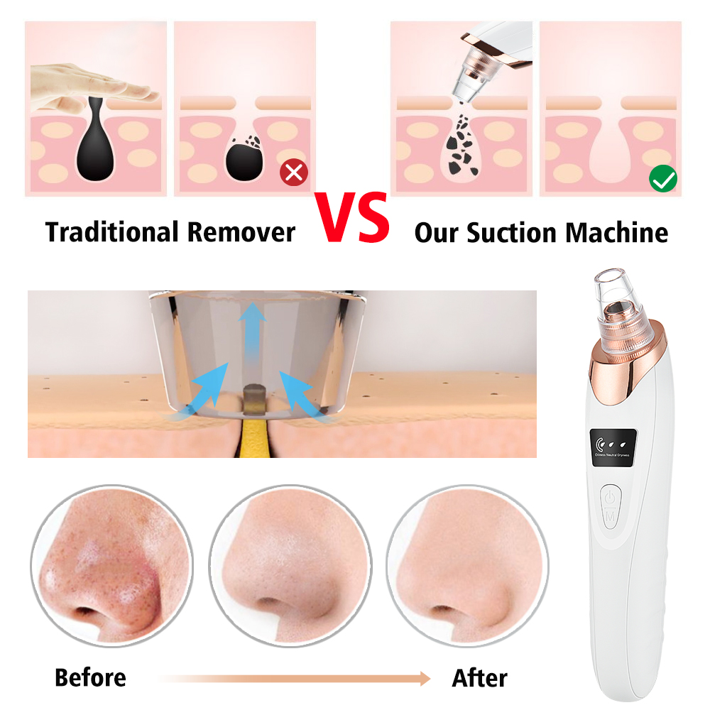 Rimozione di punti neri Aspira - Blackhead Remover Vacuum Suction recensione e prezzo