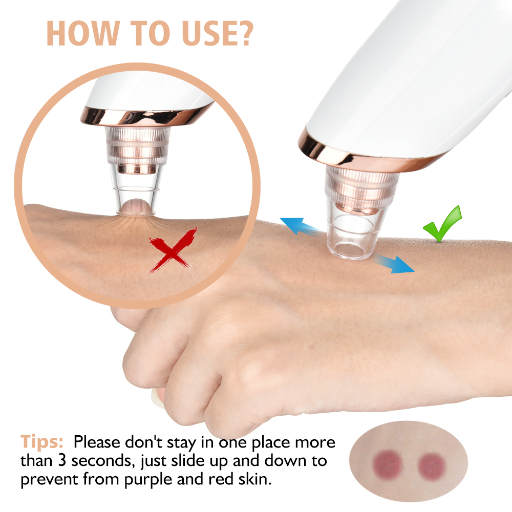 Rimozione di punti neri Aspira - Blackhead Remover Vacuum Suction recensione e prezzo